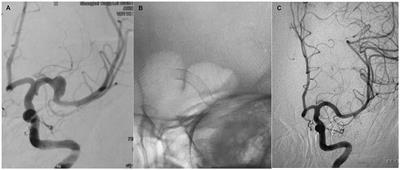 Flow diversion for unruptured fusiform aneurysms of the proximal middle cerebral artery